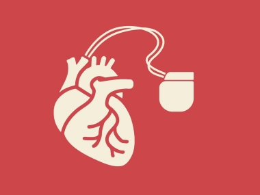 Pacemaker behandling